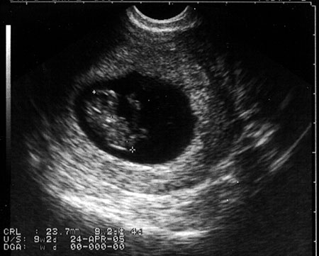 20040921-2_ultrasound