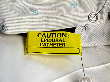 20050417-3_catheter