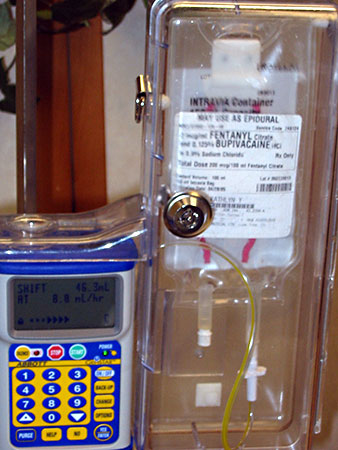 20050417-4_epidural